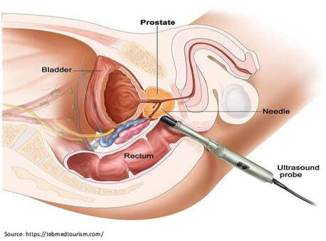 Radical (open) prostatectomy