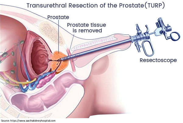 Bilateral orchiectomy