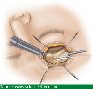 Supraorbital Craniotomy