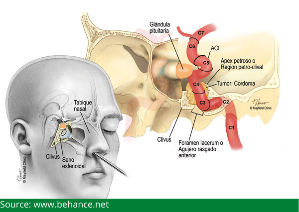 Endoscopic Endonasal Approach