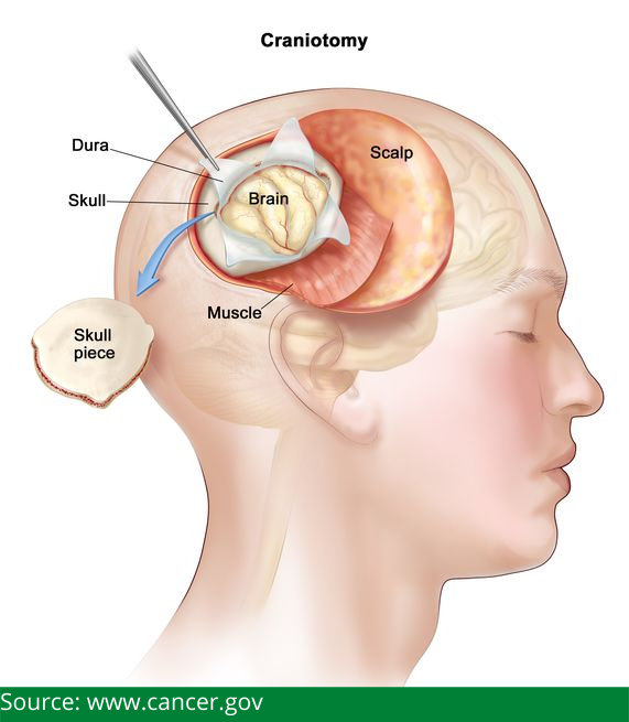 Common Keyhole Brain Surgeries