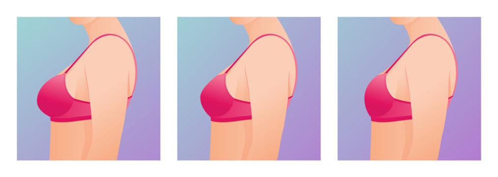 Breast Reduction Surgery Breast Reduction Surgery