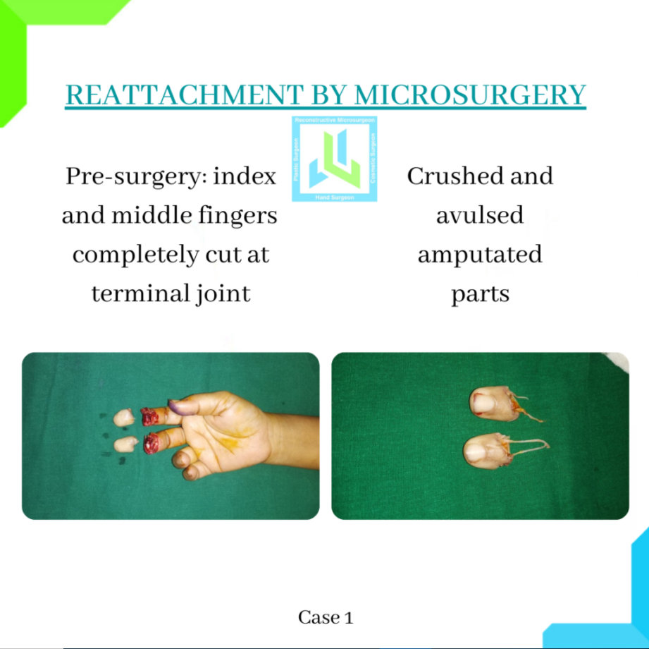 Reattachment by Microsurgery Reattachment by Microsurgery