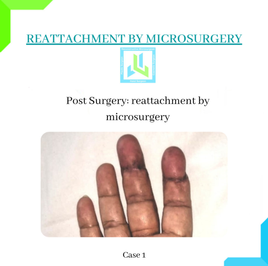 Reattachment by Microsurgery Reattachment by Microsurgery