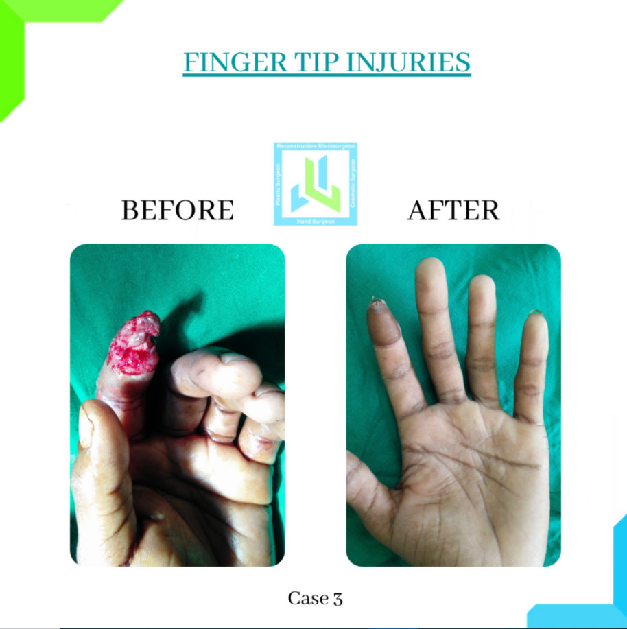 Finger Tip Injury Finger Tip Injury