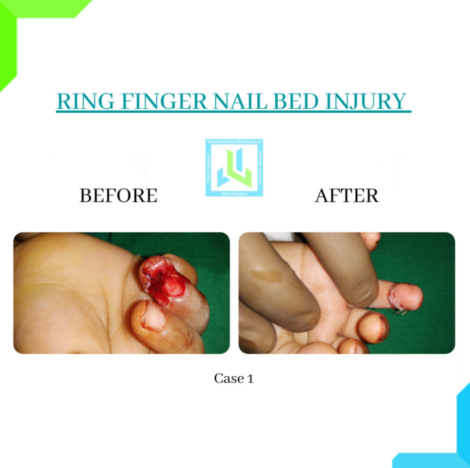 Ring Finger Nail Bed Injury Ring Finger Nail Bed Injury