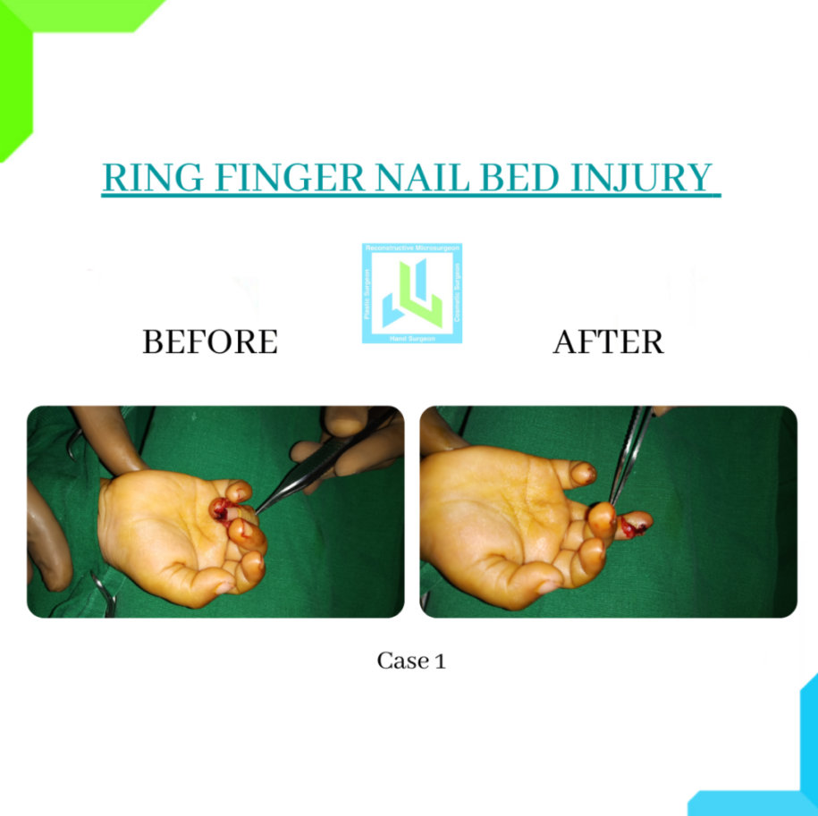 Ring Finger Nail Bed Injury Ring Finger Nail Bed Injury