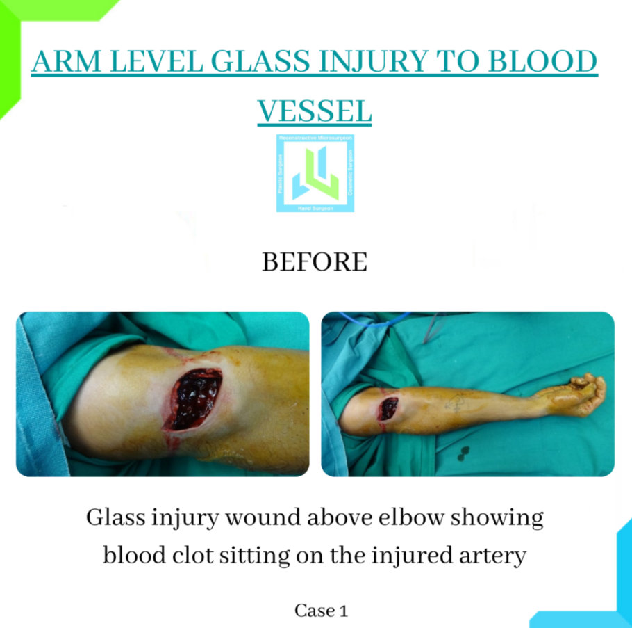 Arm Level Glass Injury Arm Level Glass Injury