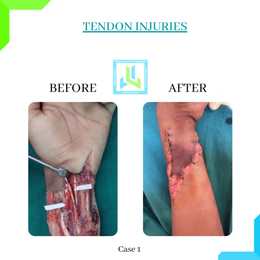 Tendon Injuries Tendon Injuries