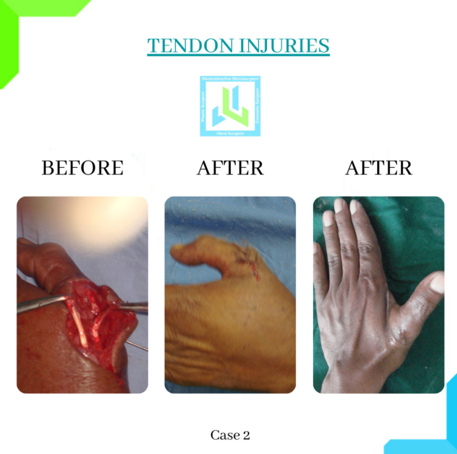 Tendon Injuries Tendon Injuries