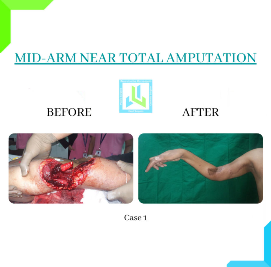 Mid-Arm Near Total Amputation Mid-Arm Near Total Amputation