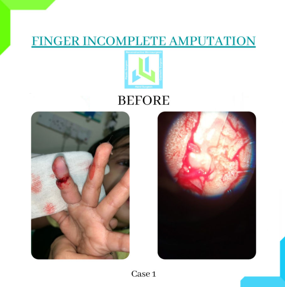 Finger Incomplete Amputation