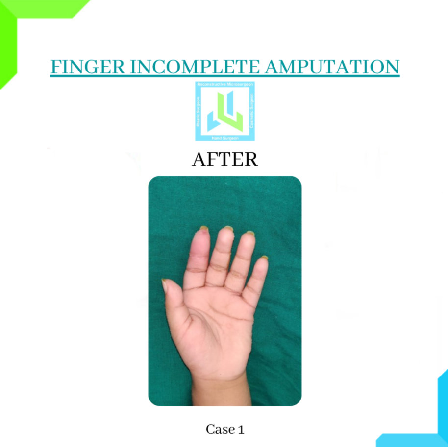 Finger Incomplete Amputation Finger Incomplete Amputation