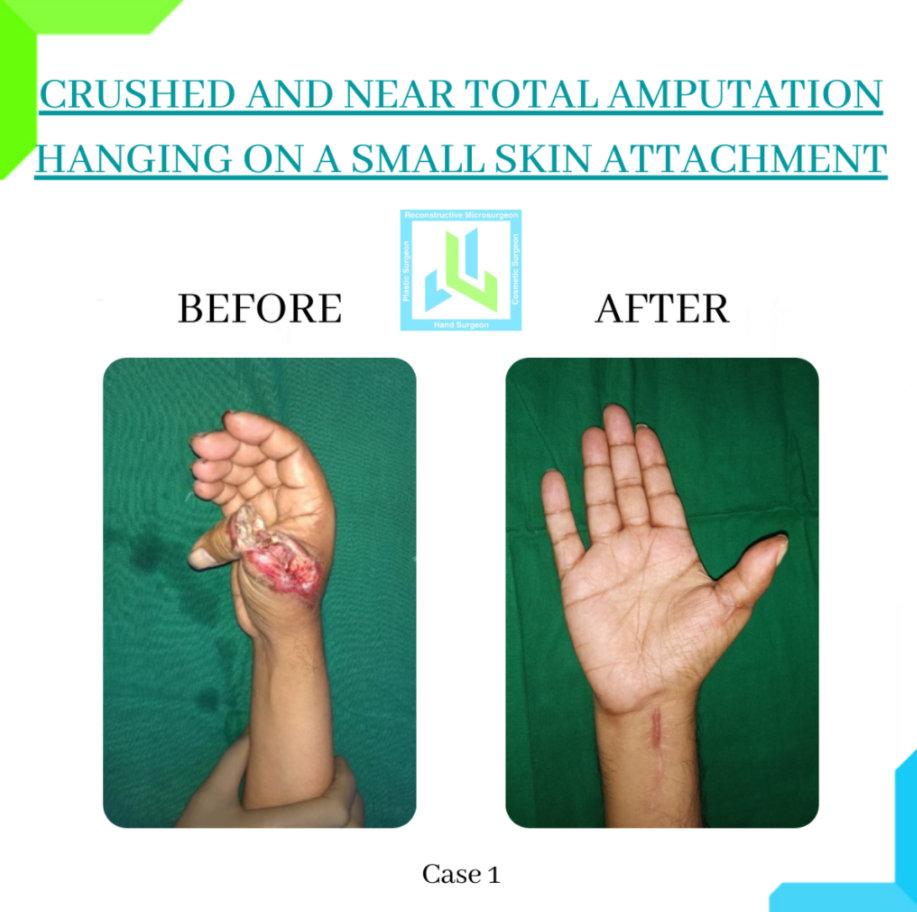 Crushed and Near Total Amputation Crushed and Near Total Amputation