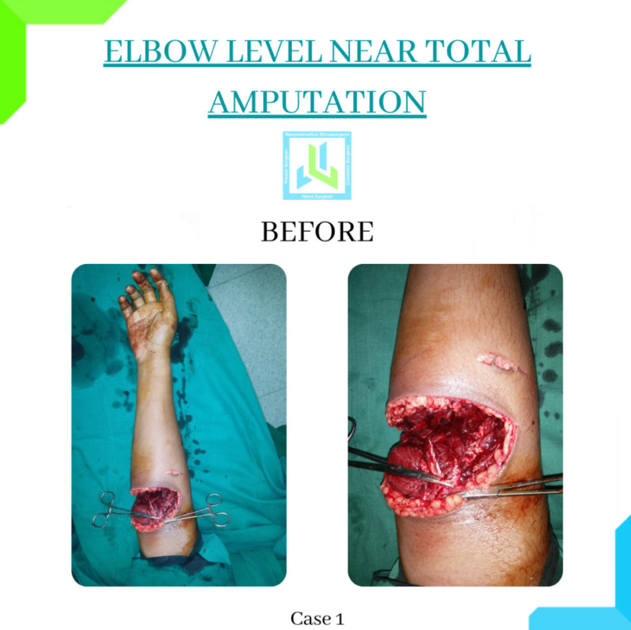 Elbow Level Near Total Amputations Elbow Level Near Total Amputations