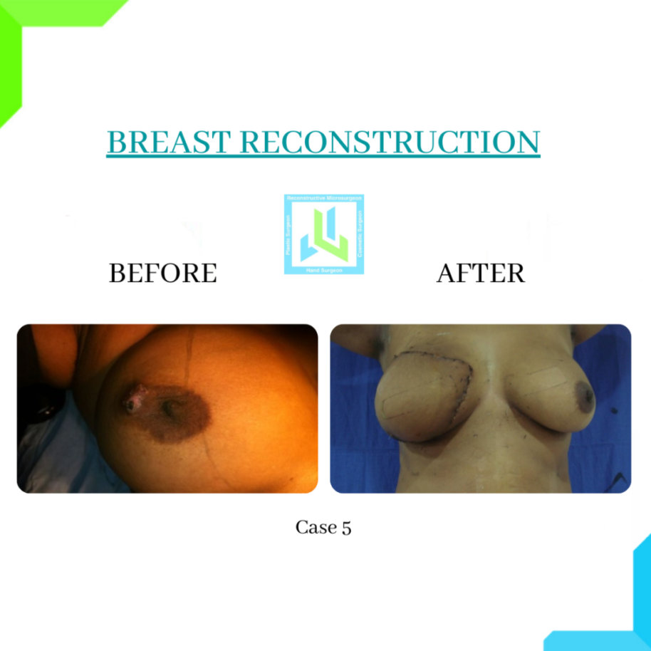 Breast Reconstruction Breast Reconstruction