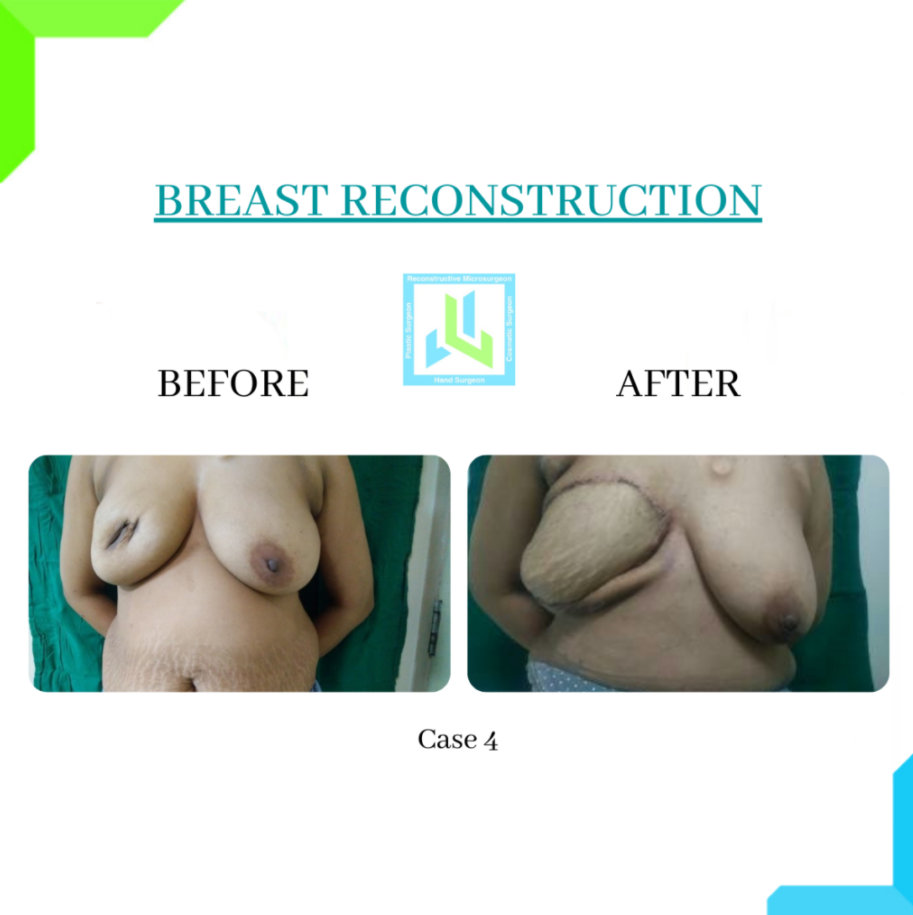 Breast Reconstruction Breast Reconstruction