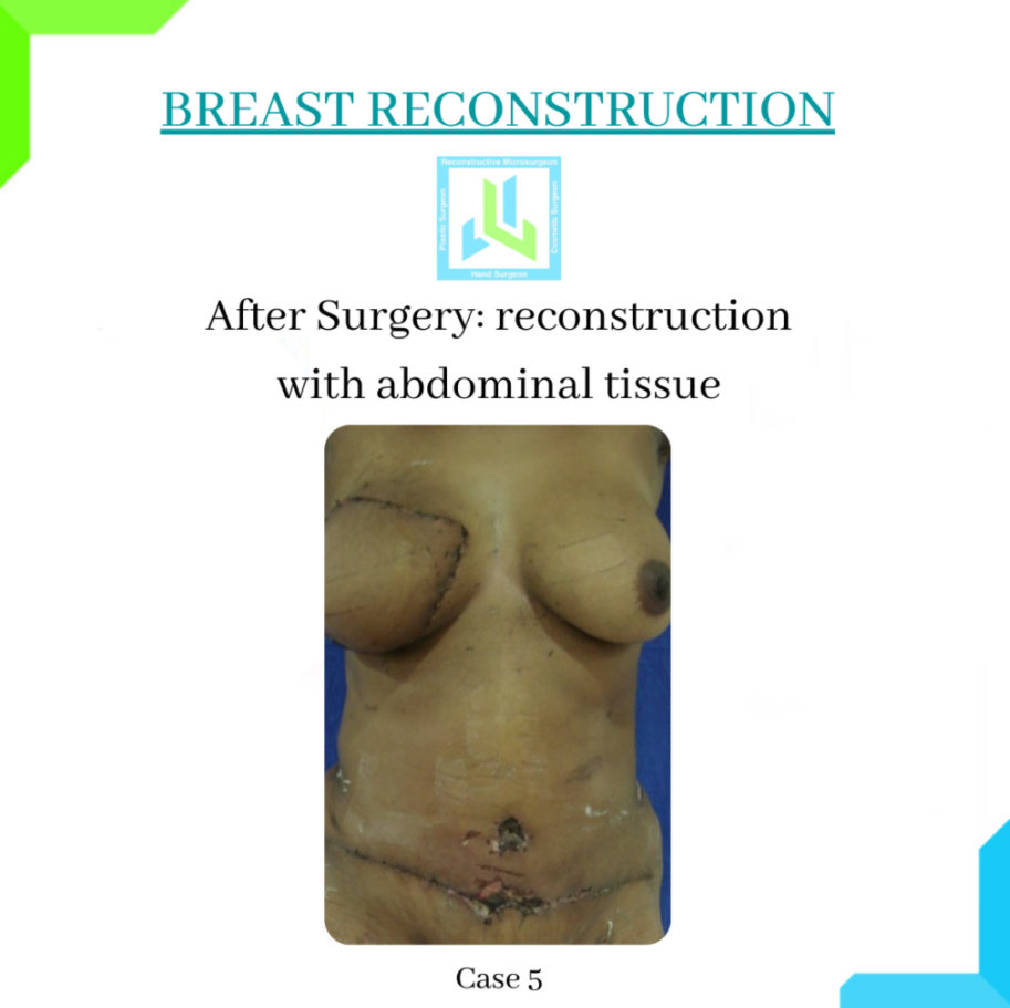 Breast Reconstruction Breast Reconstruction