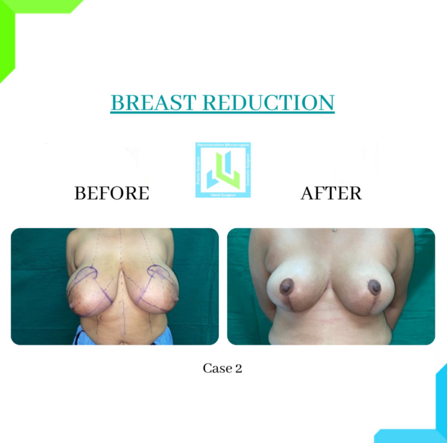 Breast Reduction Breast Reduction