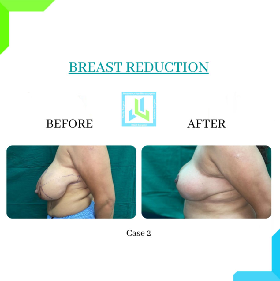 Breast Reduction Breast Reduction