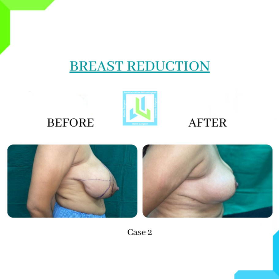 Breast Reduction Breast Reduction