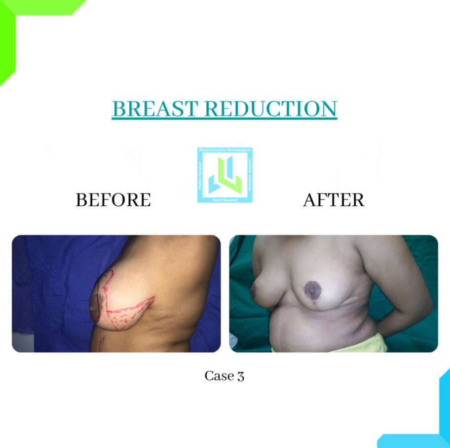 Breast Reduction Breast Reduction