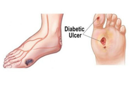 Diabetic Foot Ulcer Treatment in Mumbai