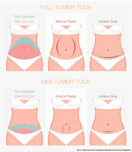 How is the Tummy Tuck Surgery performed