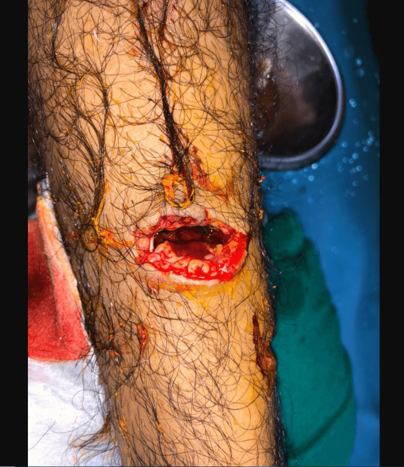 Nerve Injury Treatment Nerve Injury Treatment