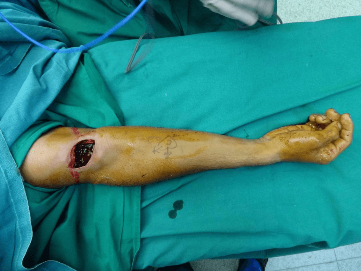 Nerve Injury Treatment Nerve Injury Treatment