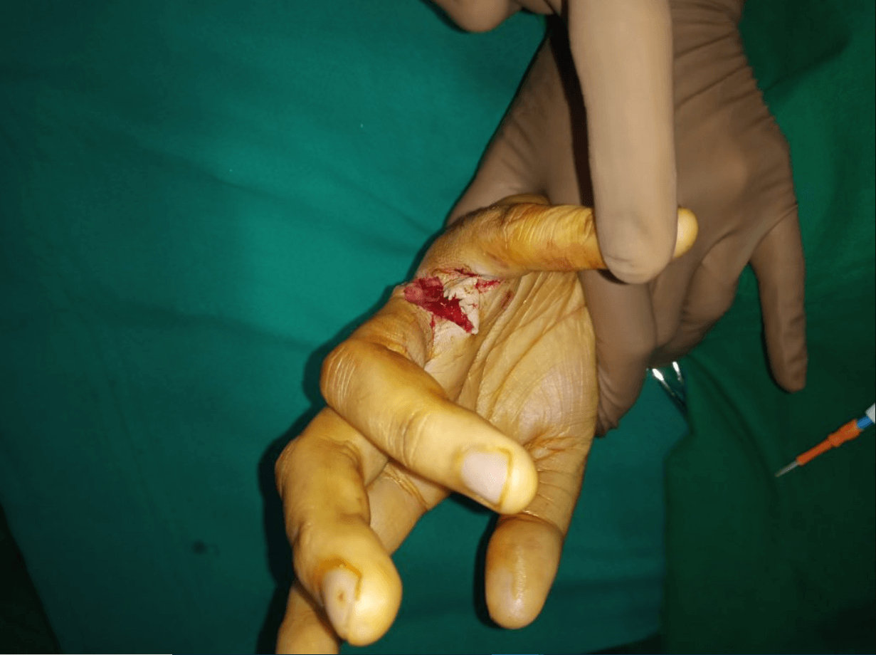 Nerve Injury Nerve Injury