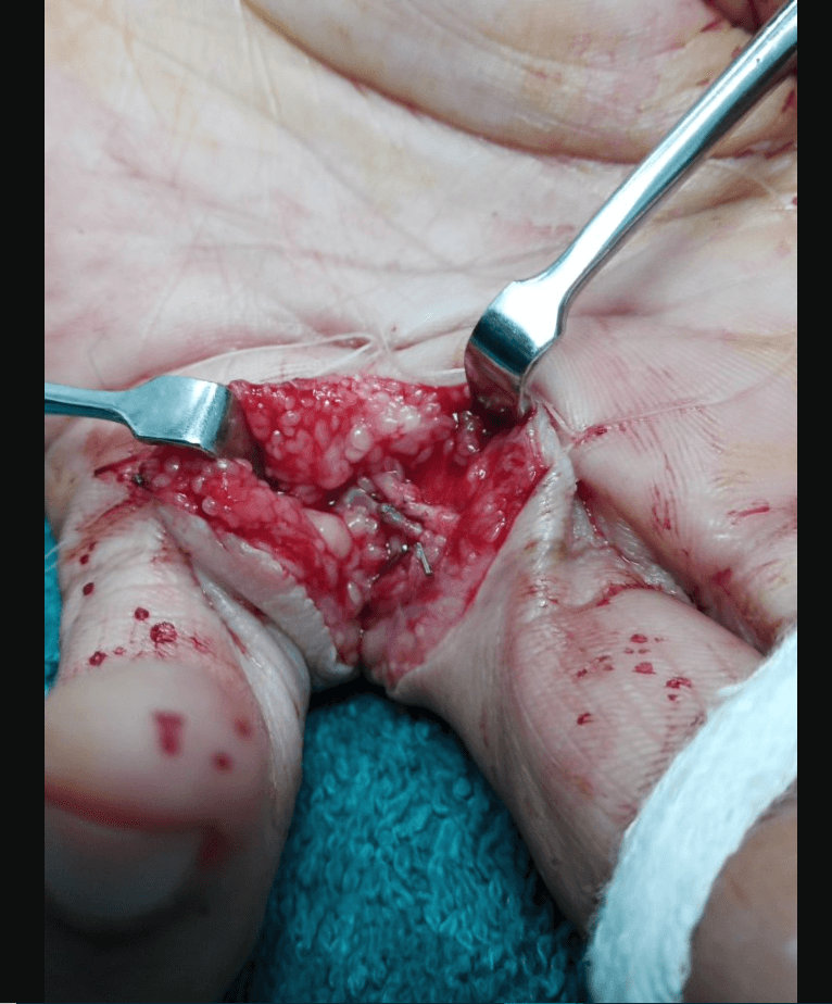 Nerve Injury Nerve Injury