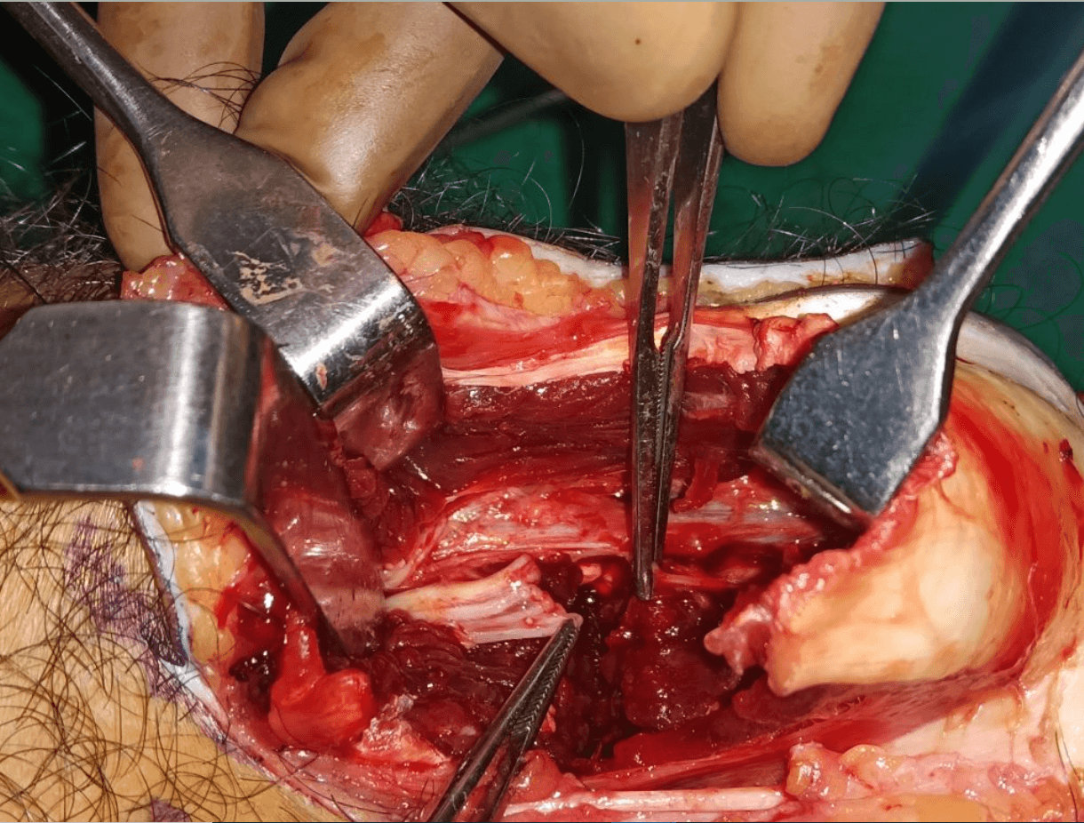 Nerve Injury Treatment Nerve Injury Treatment