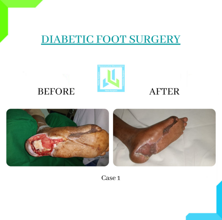 Diabetic Foot Surgery Diabetic Foot Surgery