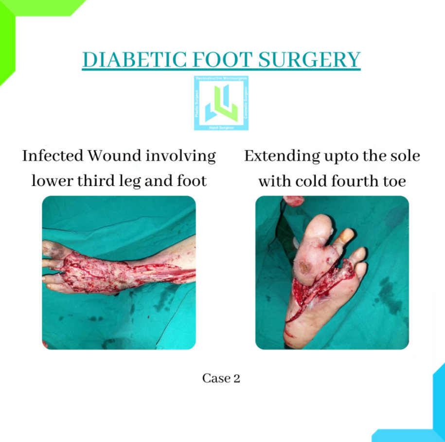 Diabetic Foot Surgery Diabetic Foot Surgery