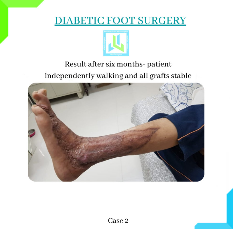 Diabetic Foot Surgery Diabetic Foot Surgery