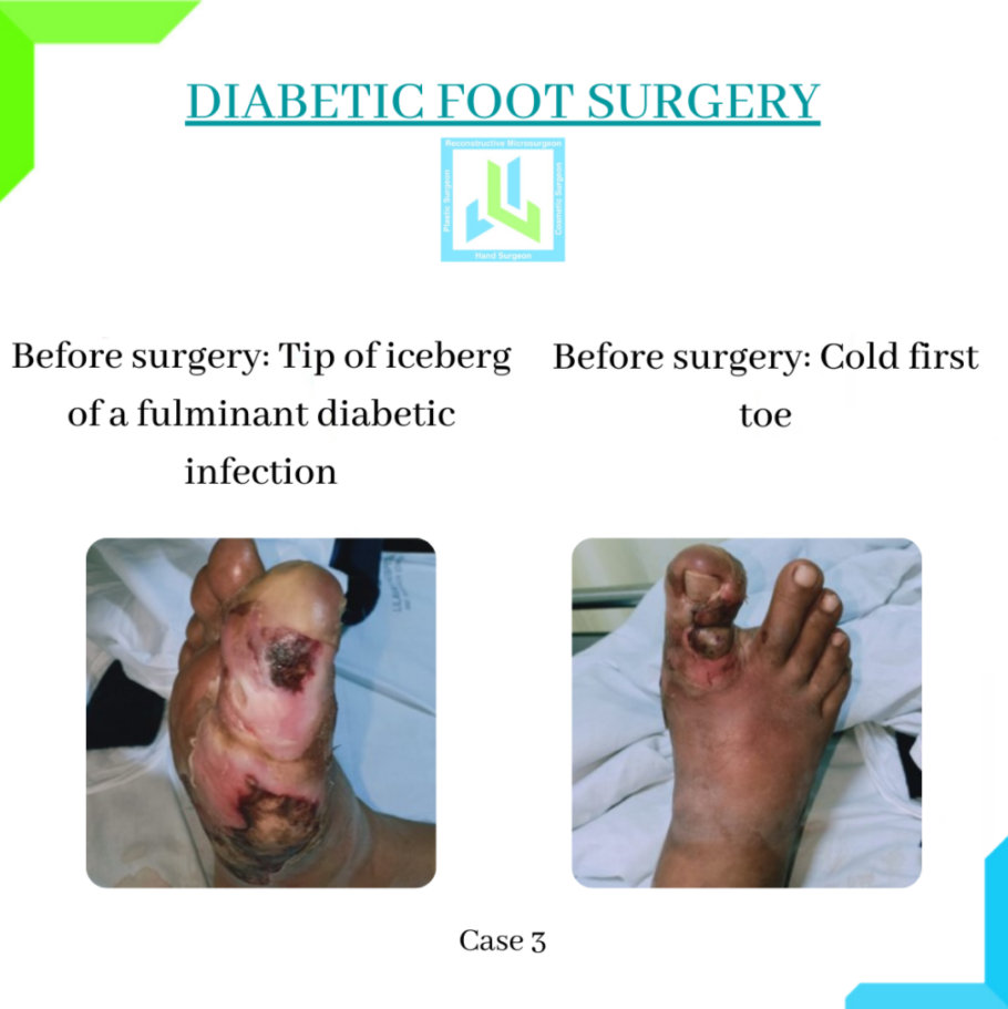 Diabetic Foot Surgery Diabetic Foot Surgery