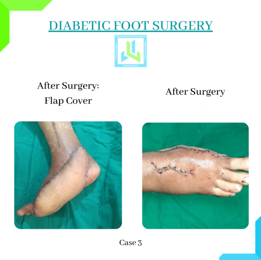 Diabetic Foot Surgery Diabetic Foot Surgery
