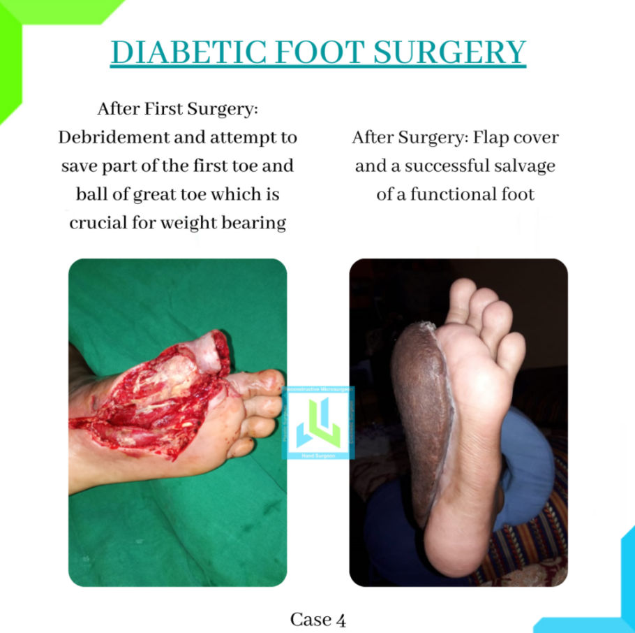 Diabetic Foot Surgery