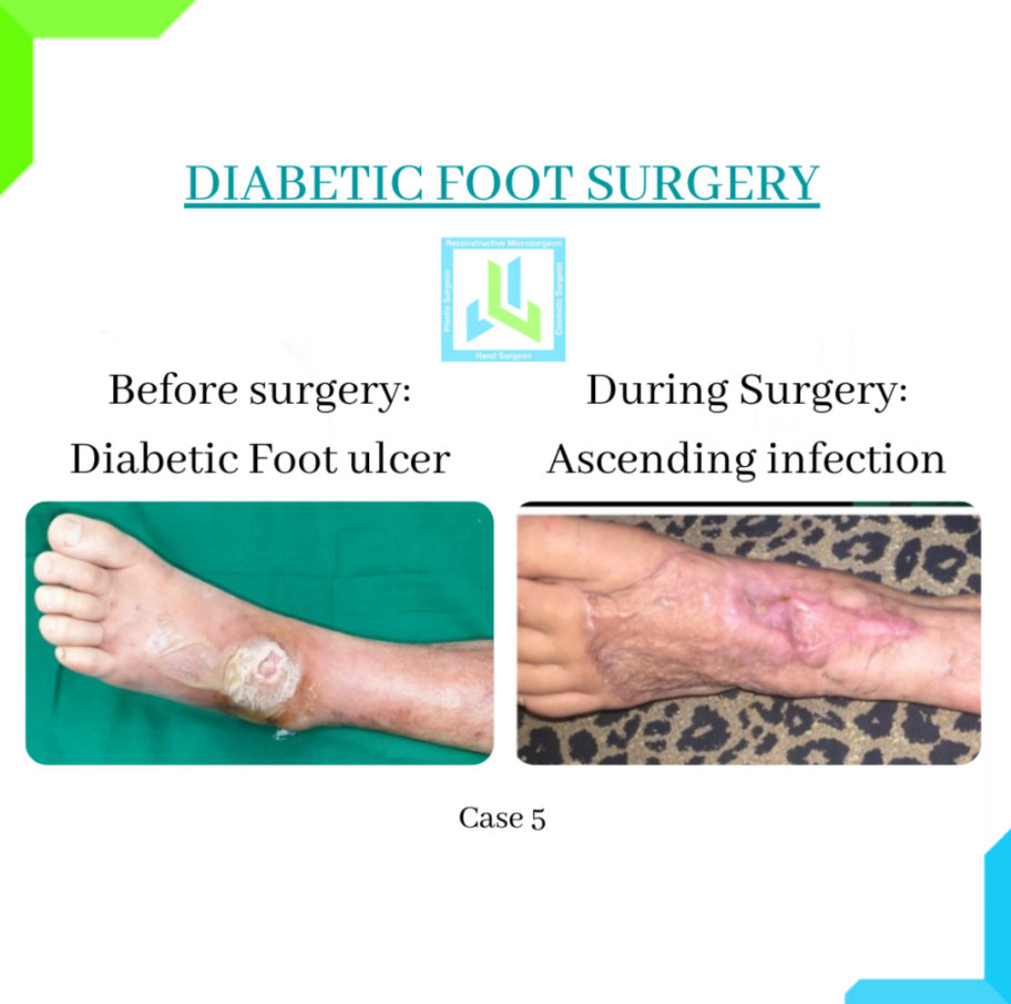 Diabetic Foot Surgery Diabetic Foot Surgery