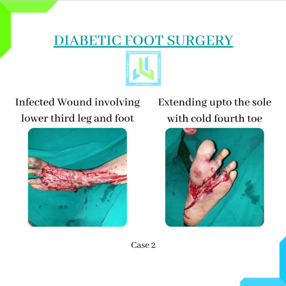Diabetic Foot Surgery Diabetic Foot Surgery