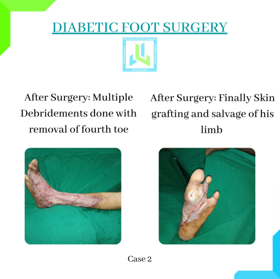 Diabetic Foot Surgery Diabetic Foot Surgery