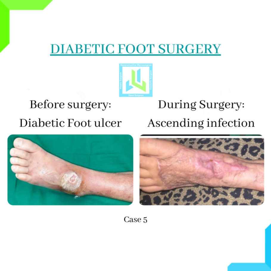 Diabetic Foot Surgery Diabetic Foot Surgery