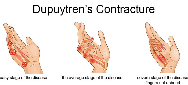 Dupuytren’s Contracture
