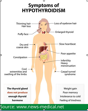  hypothyroidism