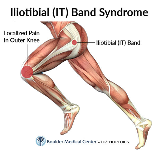 Iliotibial band (ITB) syndrome