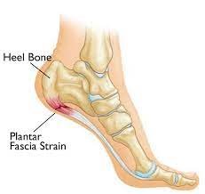 Plantar Fasciitis