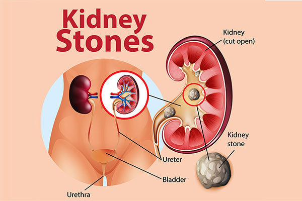 kidney stone