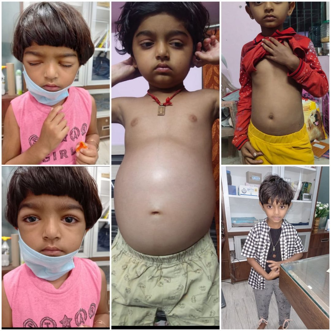 case of nephrotic syndrome