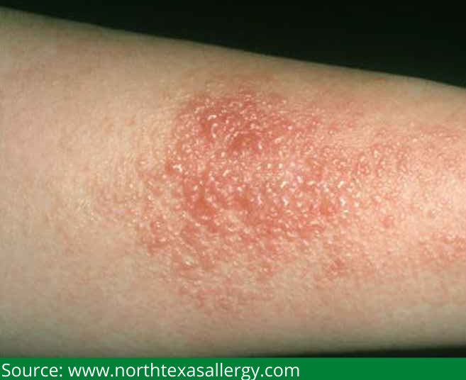 Allergic contact dermatitis